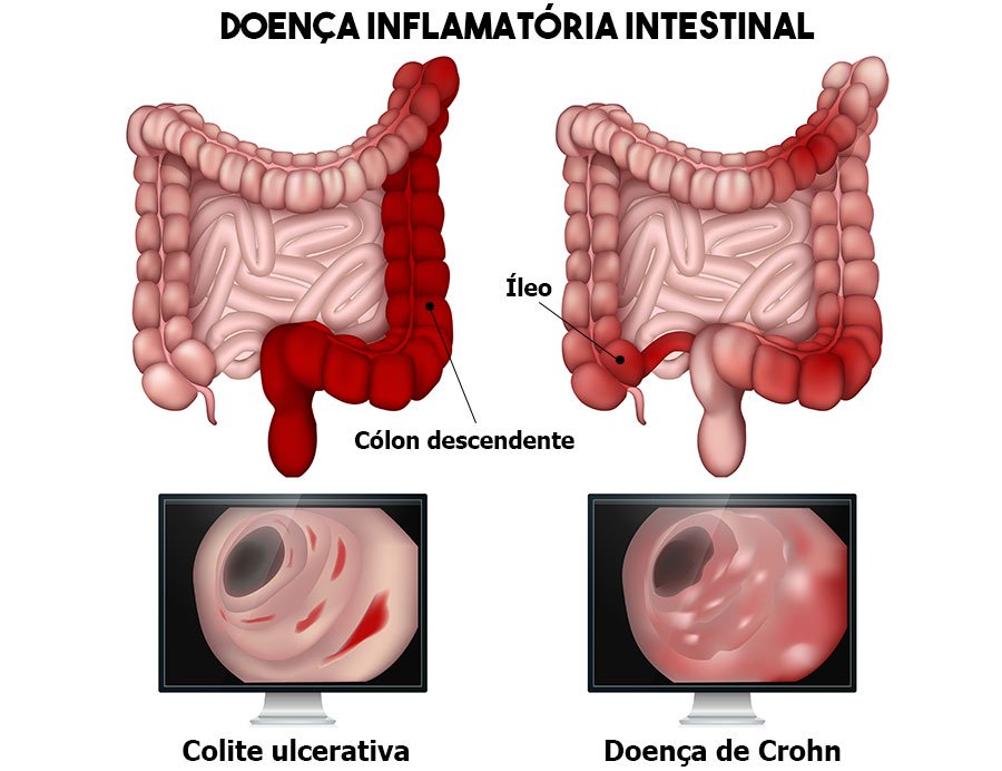 A artrite enteropática é uma manifestação articular associada a doenças inflamatórias intestinais (DII), como a doença de Crohn e a retocolite ulcerativa. Conheça mais da doença.