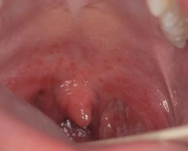 garganta inflamada, com edema e eritema