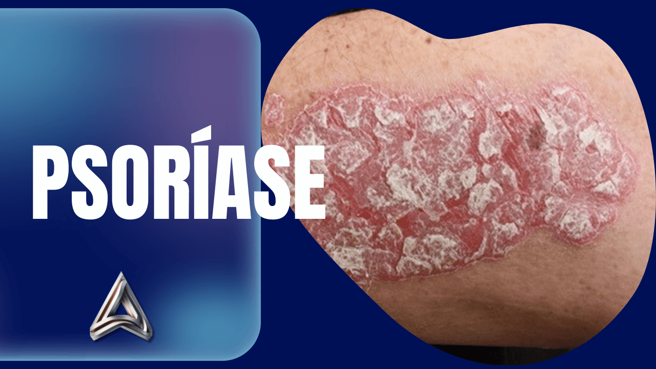 psoriase_azonomed_